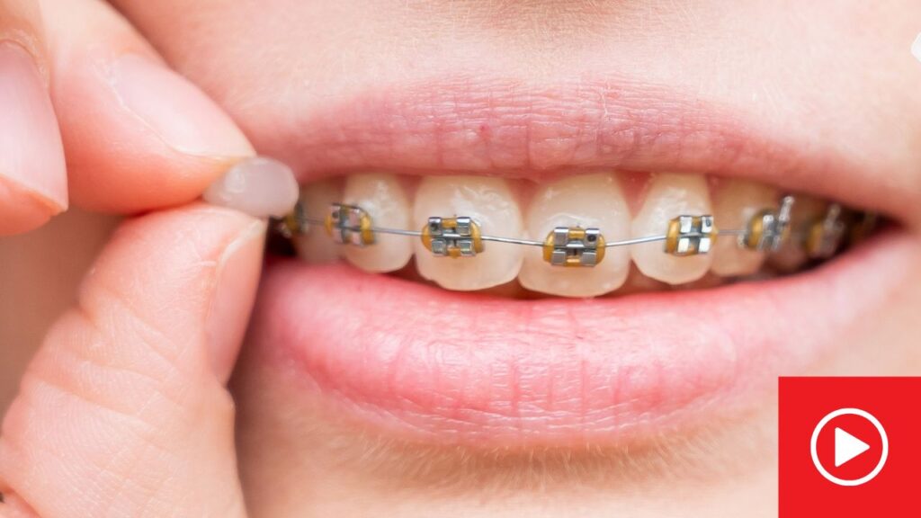 Braces